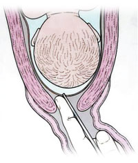 Вскрытие плодного пузыря (амниотомия)