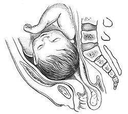 Узкий таз у беременной и роды