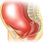 гипертонус матки