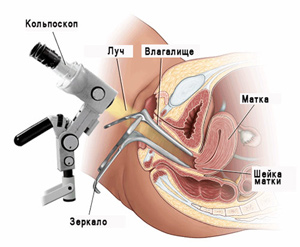 Кольпоскопия